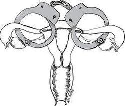 «Принудительная стерилизация» в США