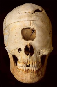 Череп, принадлежавший «циклопу»