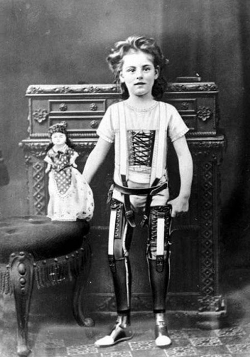 Протезы в Великобритании. Протезы в Великобритании.