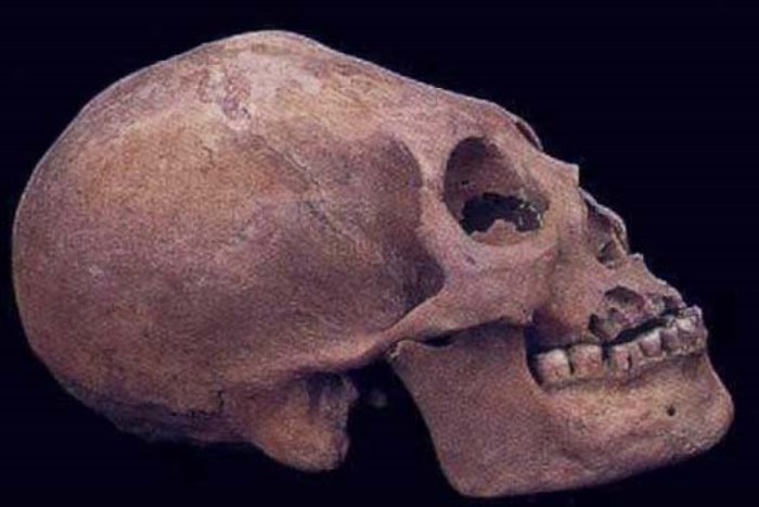 Деформированный череп