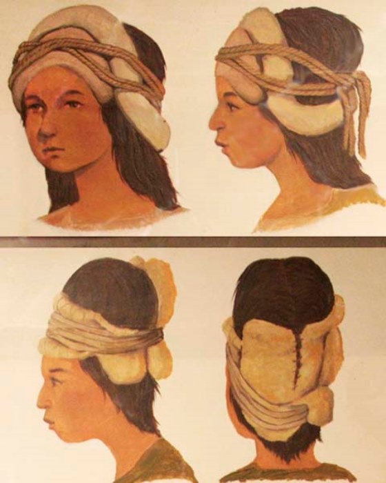 Стягивающие повязки для деформации головы