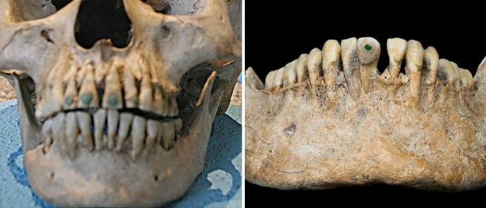 Зубы инкрустированные бирюзой. | Фото: medvoice.ru Зубы инкрустированные бирюзой. | Фото: medvoice.ru