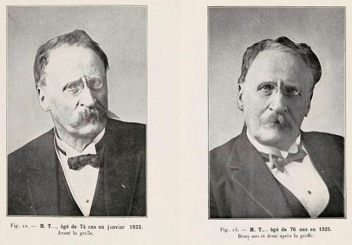 Сравнение фотографий человека до и после «омоложения» Воронова. Фото: commons.wikimedia.org.