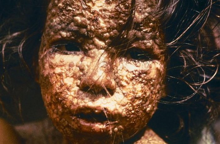 Больной оспой ребёнок. Больной оспой ребёнок.