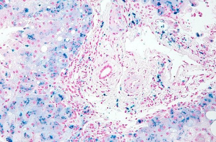 «Перегрузка организма железом». «Перегрузка организма железом».