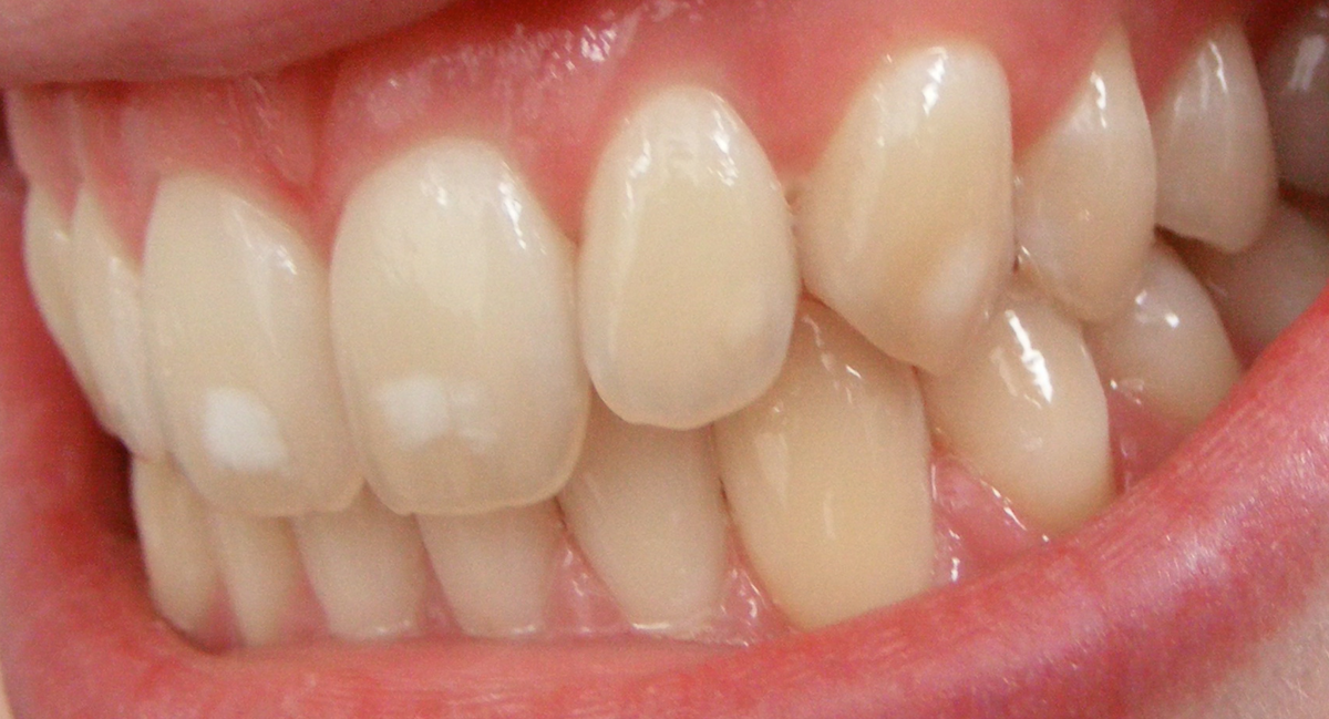 Dental_fluorosis