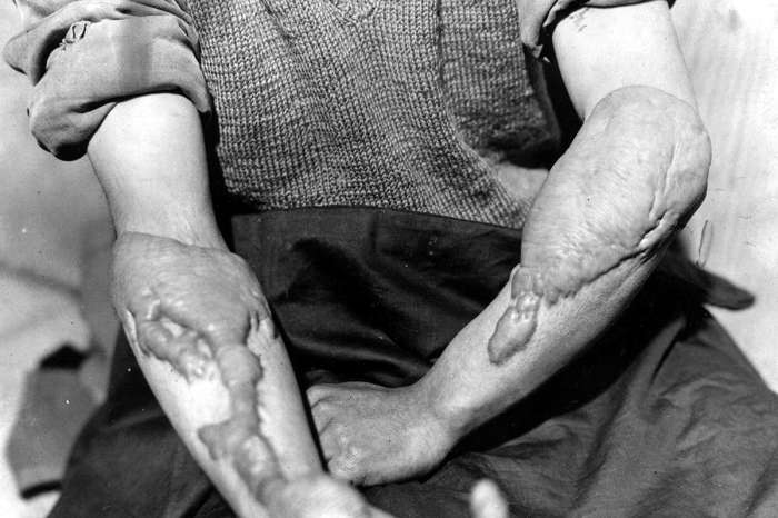 Жертвы последствий атомной бомбардировки из числа представителей мирного населения. Жертвы последствий атомной бомбардировки из числа представителей мирного населения.