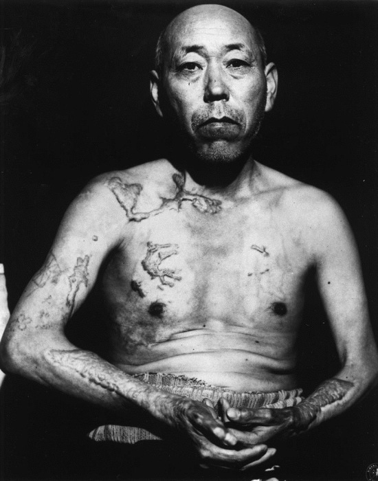 Житель Хиросимы Теравама, переживший атомную бомбардировку, июнь 1945 года.