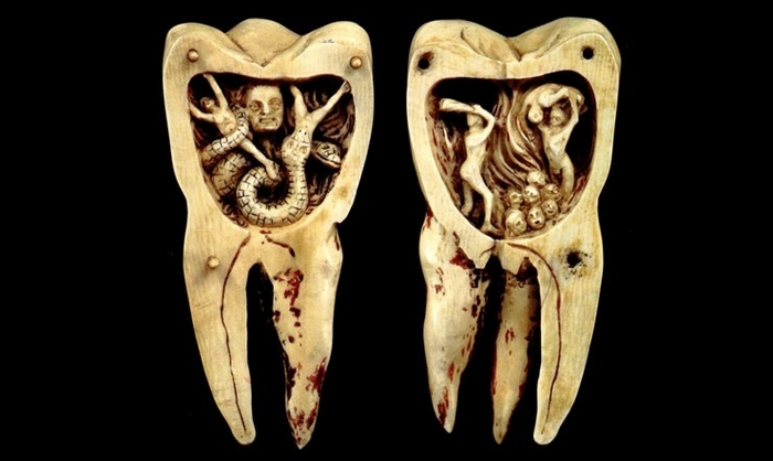 Дырки в зубах не пломбировали, считая, что эта проделки червя, которого нужно прижигать железом или заливать кислотой. / Фото:sundukistorii.blogspot.com