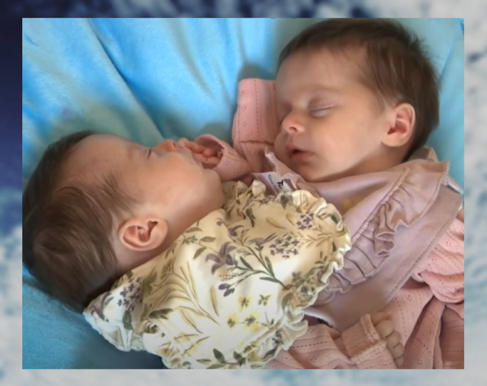 Как живут разделённые годовалые сиамские близнецы из Ирландии: Одна болтушка, а вторая прячется за диван