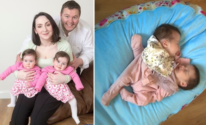 Как живут разделённые годовалые сиамские близнецы из Ирландии: Одна болтушка, а вторая прячется за диван